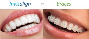 invisalign-vs-braces