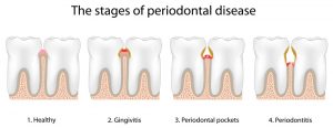 stages_gingivitis_sm